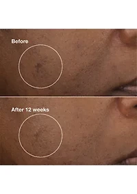 Even Better Clinical™ Brightening Moisturizer