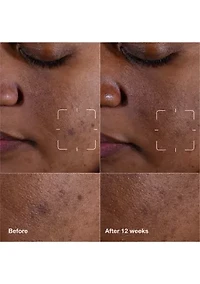 Even Better Clinical™ Dark Spot Clearing Serum with Vitamin C