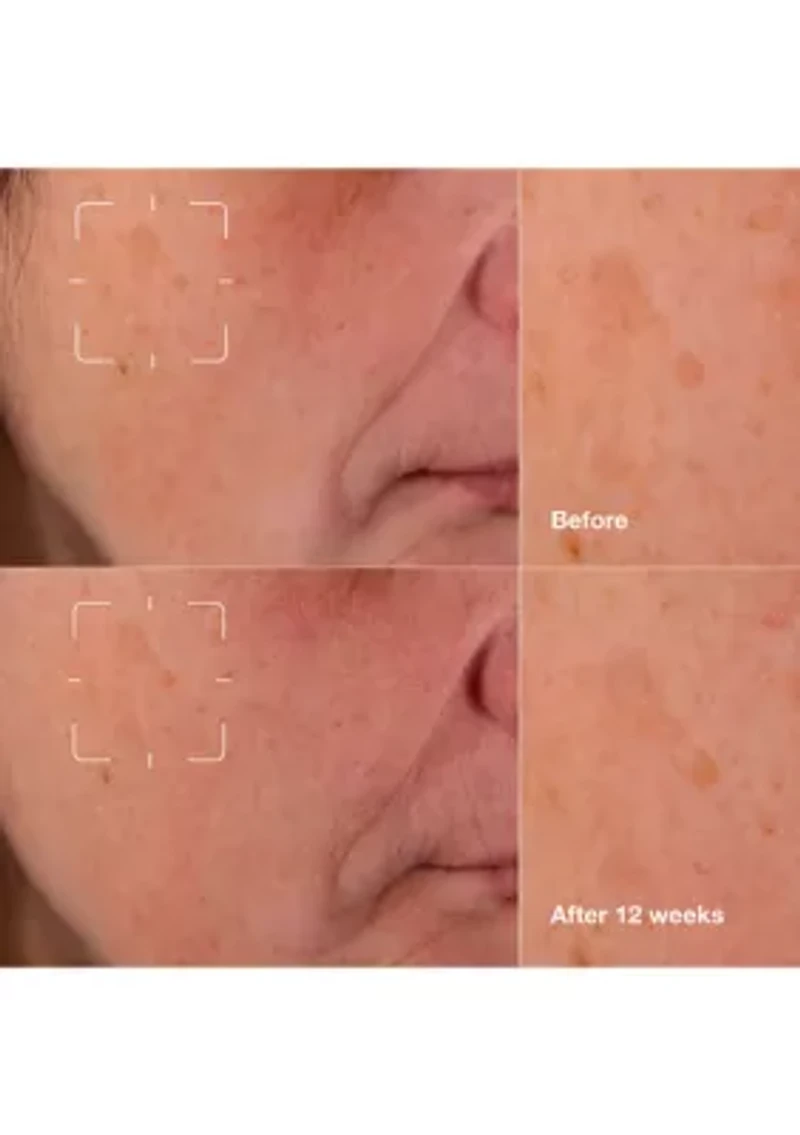 Even Better Clinical™ Dark Spot Clearing Serum with Vitamin C