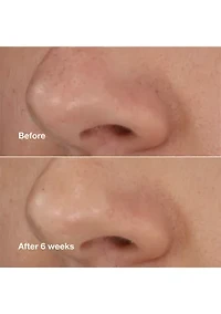 Blackhead Solutions Self-Heating Blackhead Extractor