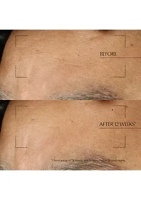 Advanced Night Repair Moisturizing Overnight Treatment with Hyaluronic Acid