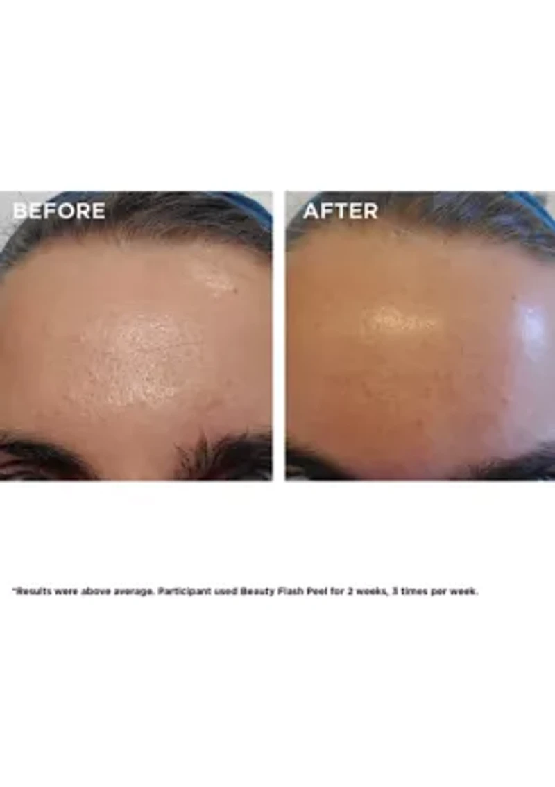 Beauty Flash Peel with BHA & AHA