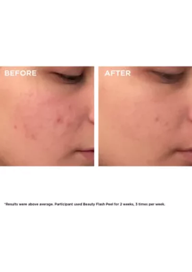 Beauty Flash Peel with BHA & AHA
