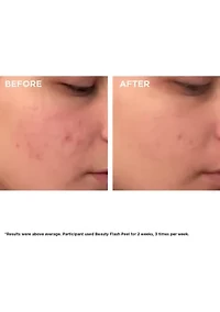 Beauty Flash Peel with BHA & AHA