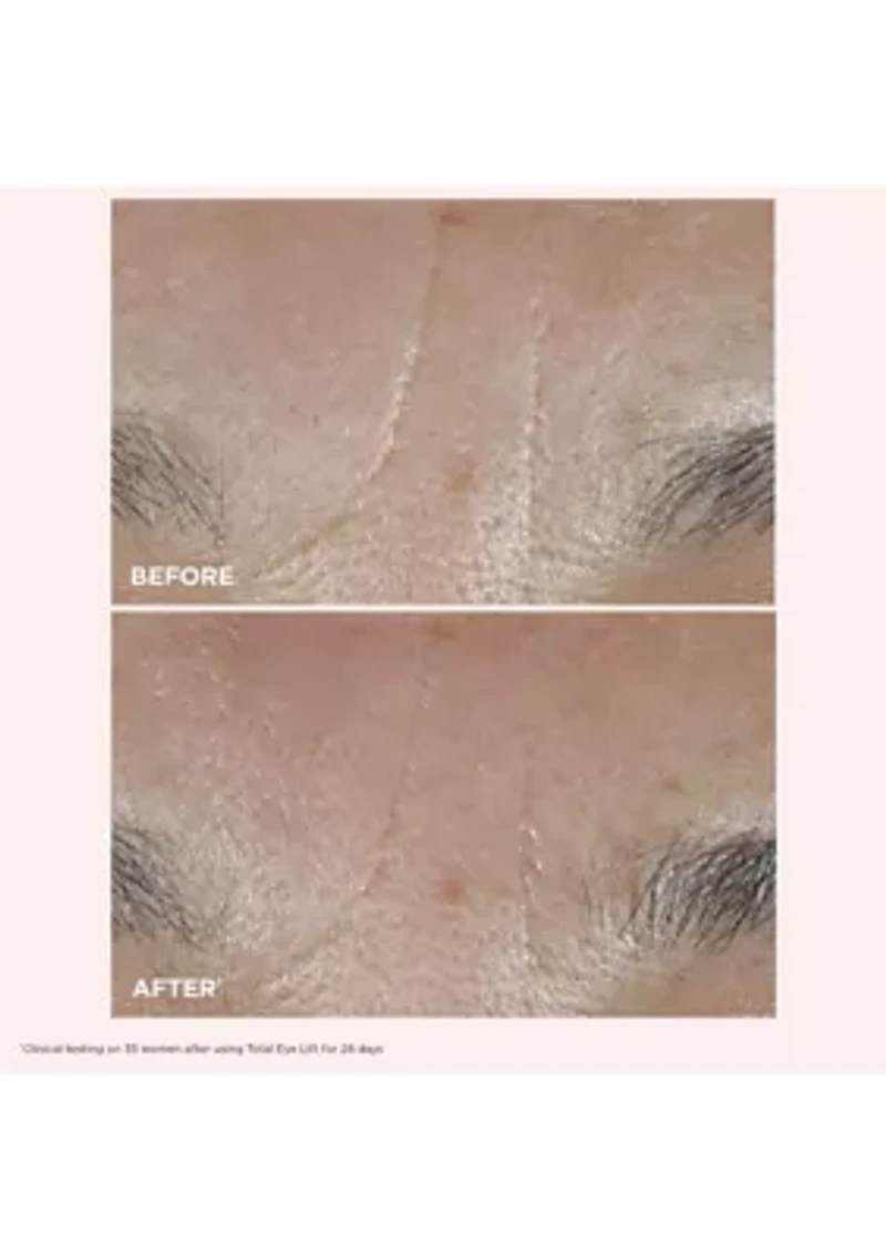 Total Eye Lift Set for Firming, Wrinkles, Dark Circles & Puffiness - $141 Value!