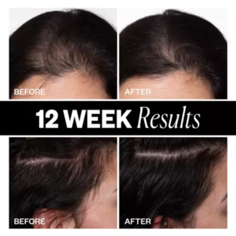 Sponsored High Density Scalp Treatment