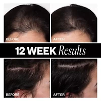 Sponsored High Density Scalp Treatment