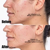 Peacekeeper Azaleic And Salicylic Acid Acne Treatment Serum