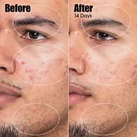 Peacekeeper Azaleic And Salicylic Acid Acne Treatment Serum