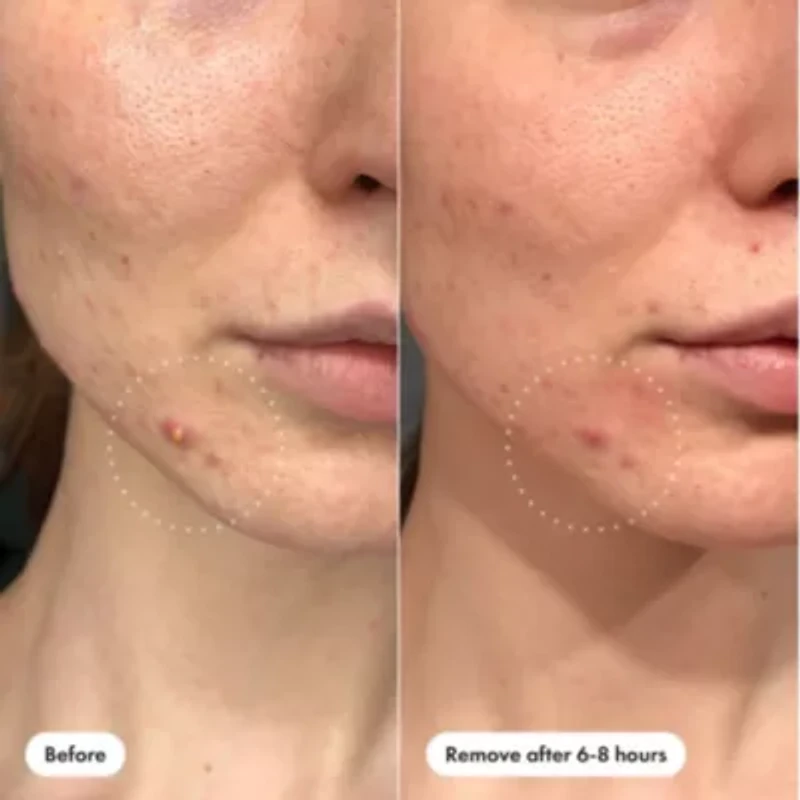 Mighty Patch Invisible+ Daytime Acne Pacthes
