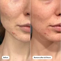Mighty Patch Invisible+ Daytime Acne Pacthes
