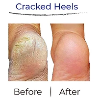 RevivaFoot Exfoliating Foot Peel Masks (2pk) | As Seen On Social!