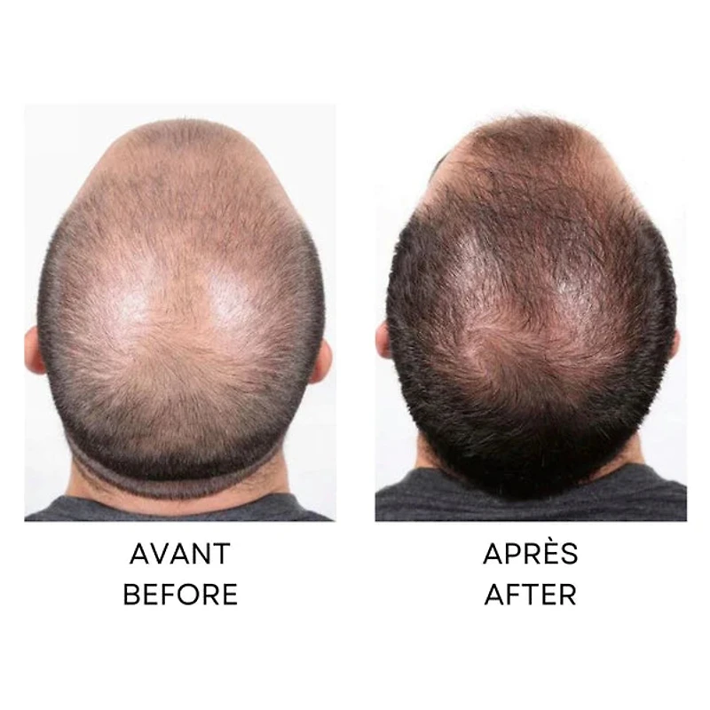 Capillus 82 Laser Theraphy Hair Regrowth System