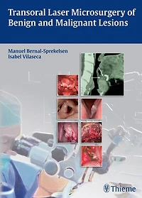 Transoral Laser Microsurgery Of Benign And Malignant Lesions