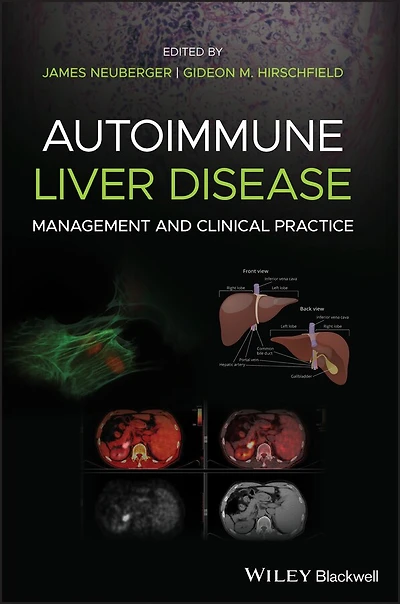 Autoimmune Liver Disease: Management And Clinical Practice