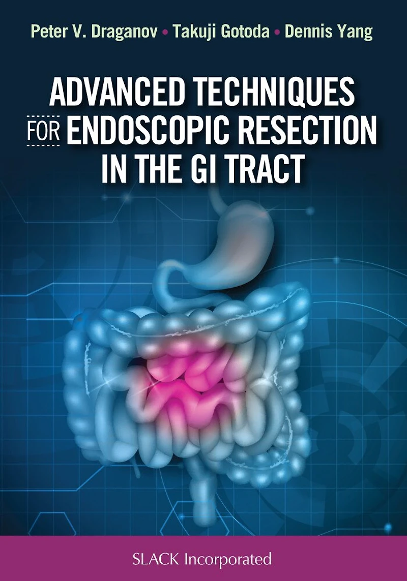 Advanced Techniques for Endoscopic Resection the GI Tract