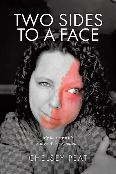 Two Sides to a Face: My Journey with Sturge Weber Syndrome
