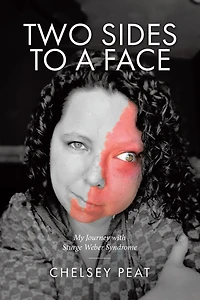 Two Sides to a Face: My Journey with Sturge Weber Syndrome