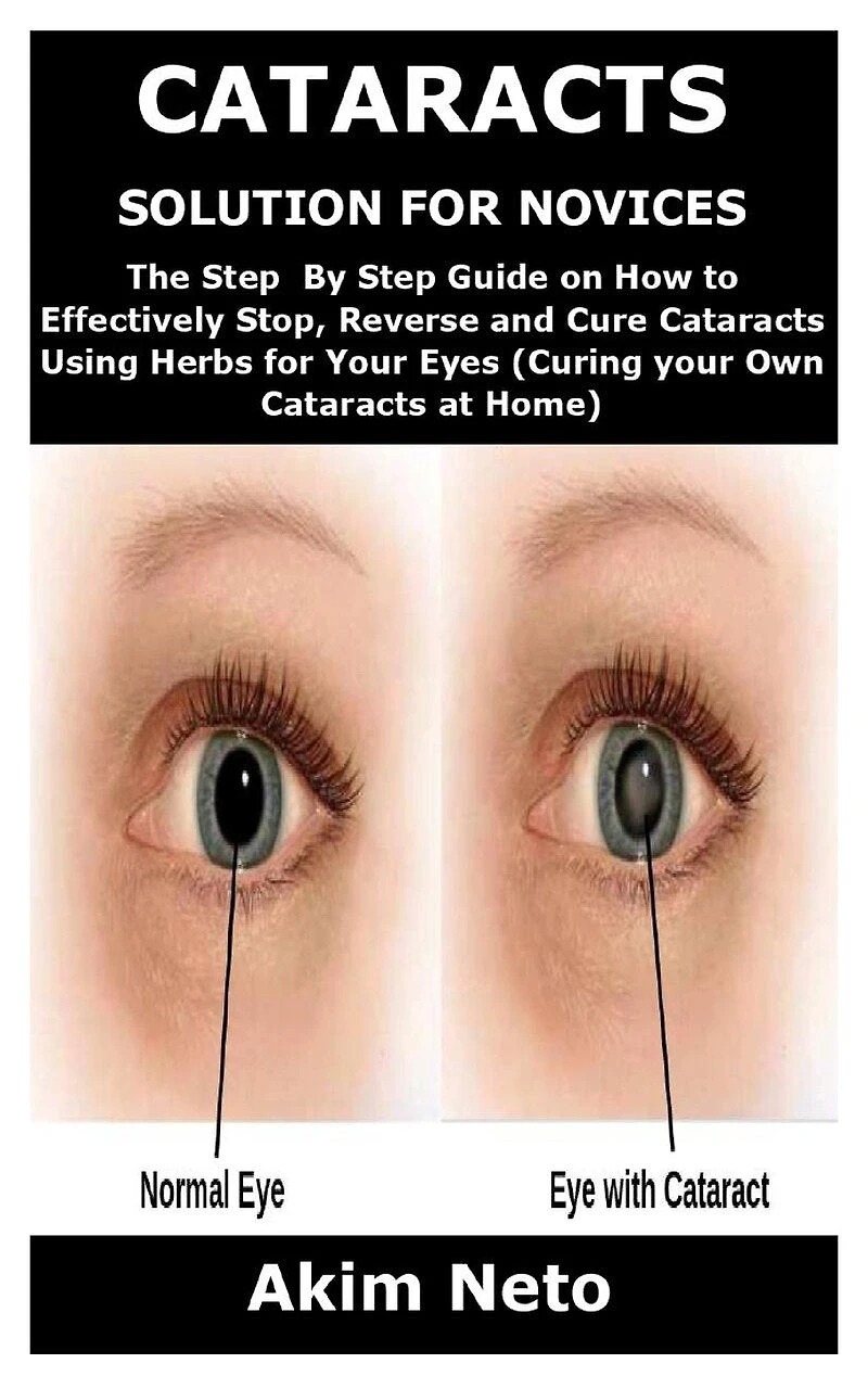 Cataracts Solution for Novices: The Step By Step Guide on How to Effectively Stop, Reverse and Cure Cataracts Using Herbs for Your Eyes (Curing your Own Cataracts at Home)
