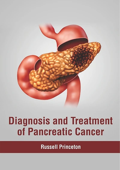 Diagnosis And Treatment Of Pancreatic Cancer