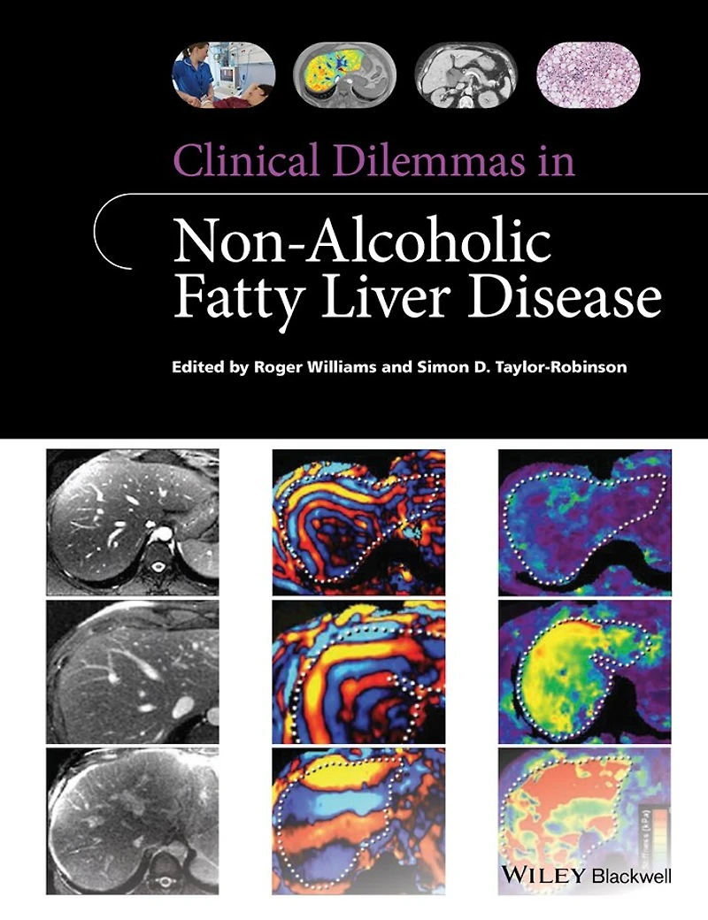 Clinical Dilemmas Non-Alcoholic Fatty Liver Disease