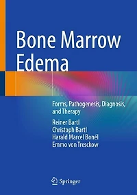 Bone Marrow Edema: Forms, Pathogenesis, Diagnosis, and Therapy