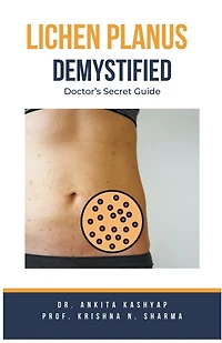 Lichen Planus Demystified Doctors Secret Guide