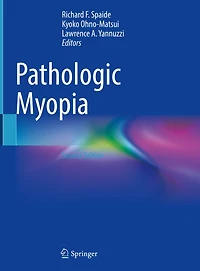 Pathologic Myopia