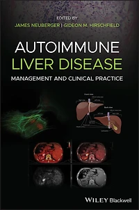 Autoimmune Liver Disease: Management And Clinical Practice
