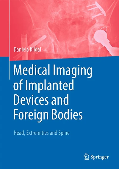 Medical Imaging of Implanted Devices and Foreign Bodies: Head, Extremities Spine