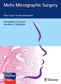 Mohs Micrographic Surgery: From Layers To Reconstruction