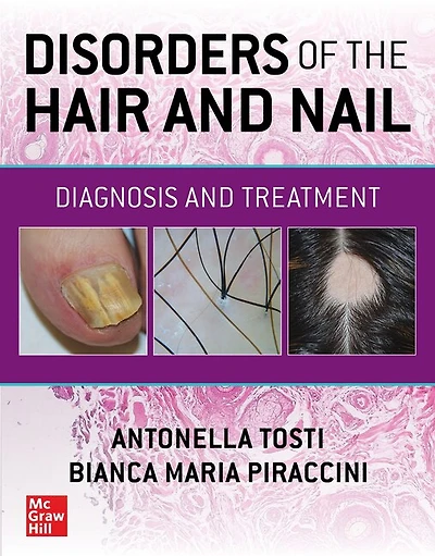 Disorders of the Hair and Nail: Diagnosis Treatment