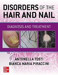 Disorders of the Hair and Nail: Diagnosis Treatment