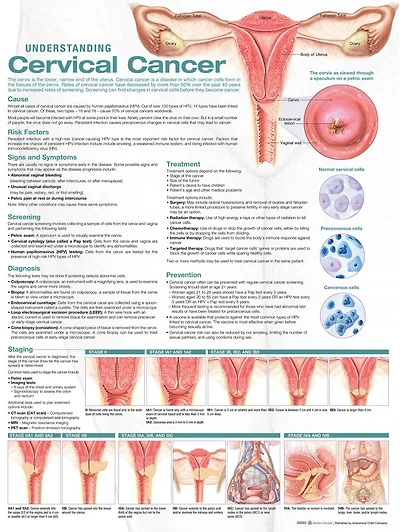 Understanding Cervical Cancer Anatomical Chart