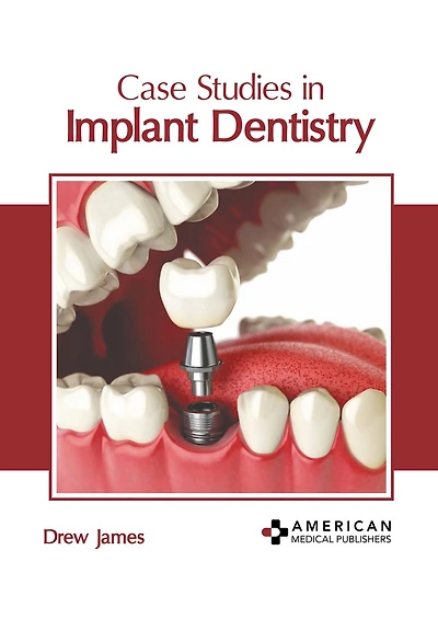 Case Studies in Implant Dentistry