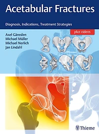 Acetabular Fractures: Diagnosis, Indications, Treatment Strategies
