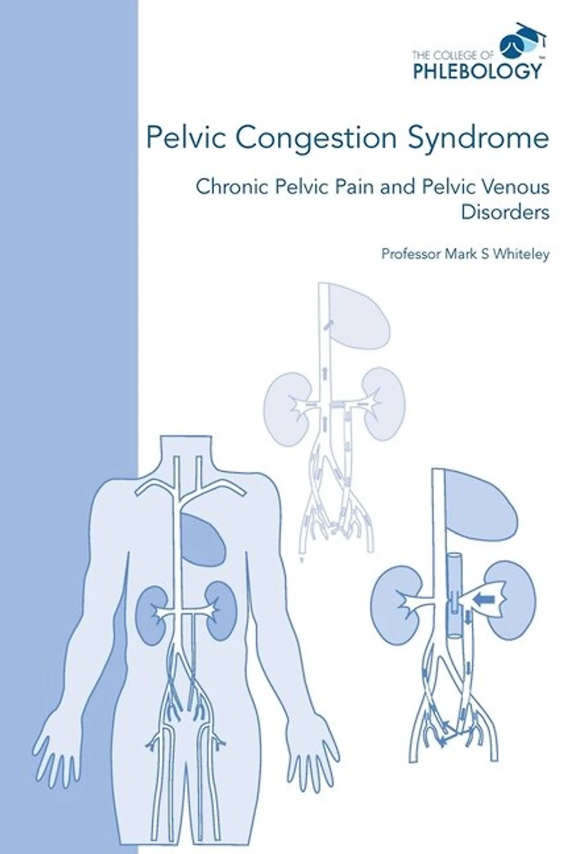Pelvic Congestion Syndrome - Chronic Pelvic Pain And Pelvic Venous Disorders