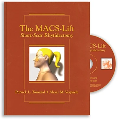 The Macs-lift: Short-scar Rhytidectomy