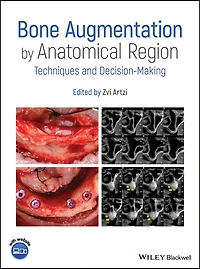 Bone Augmentation by Anatomical Region: Techniques and Decision-Making