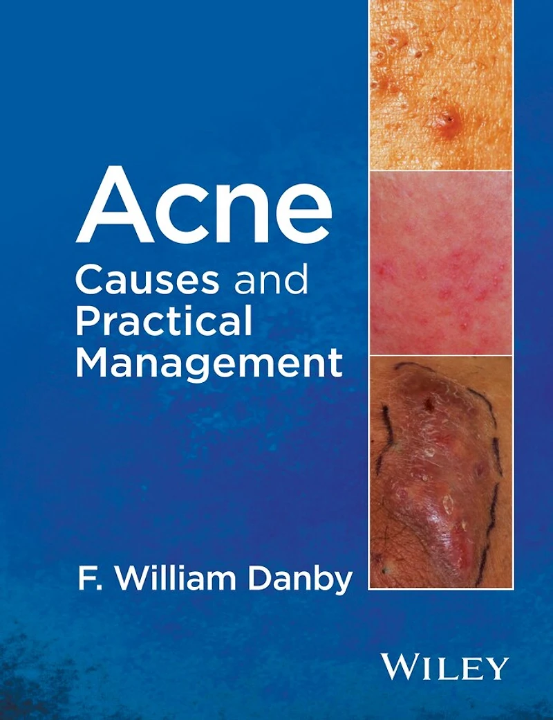 Acne: Causes and Practical Management