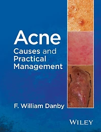 Acne: Causes and Practical Management