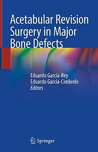 Acetabular Revision Surgery Major Bone Defects