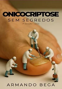 Onicocriptose Sem Segredos