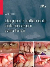 Diagnosi e trattamento delle forcazioni parodontali