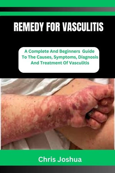 REMEDY FOR VASCULITIS: A Complete And Beginners Guide To The Causes, Symptoms, Diagnosis And Treatment Of Vasculitis