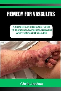 REMEDY FOR VASCULITIS: A Complete And Beginners Guide To The Causes, Symptoms, Diagnosis And Treatment Of Vasculitis