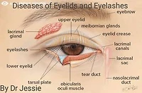 Diseases of the Eyelids and Eyelashes