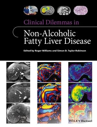 Clinical Dilemmas Non-Alcoholic Fatty Liver Disease