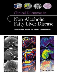 Clinical Dilemmas Non-Alcoholic Fatty Liver Disease