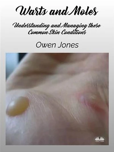 Warts And Moles: Understanding And Managing These Common Skin Conditions